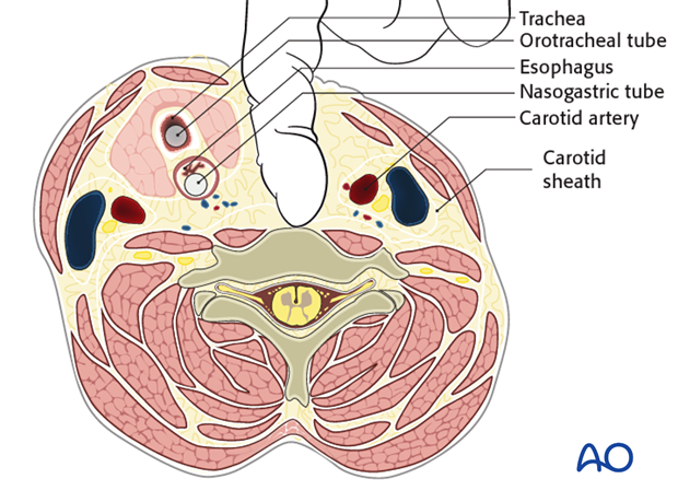 anterior approach to the cervical spine