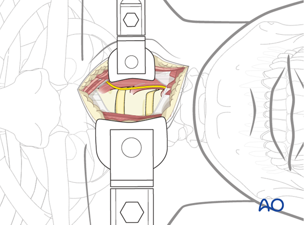 anterior approach to the cervical spine