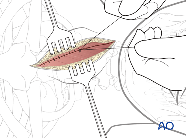 anterior approach to the cervical spine