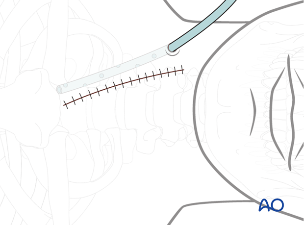 anterior approach to the cervical spine