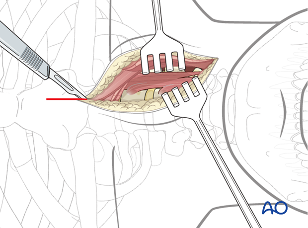 anterior approach to the cervico thoracic junction