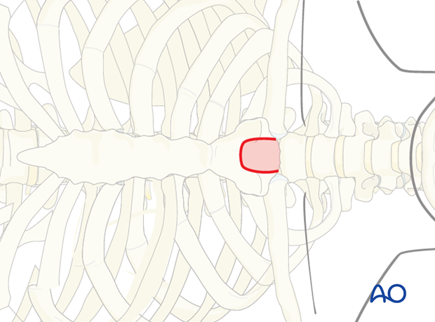 anterior approach to the cervico thoracic junction