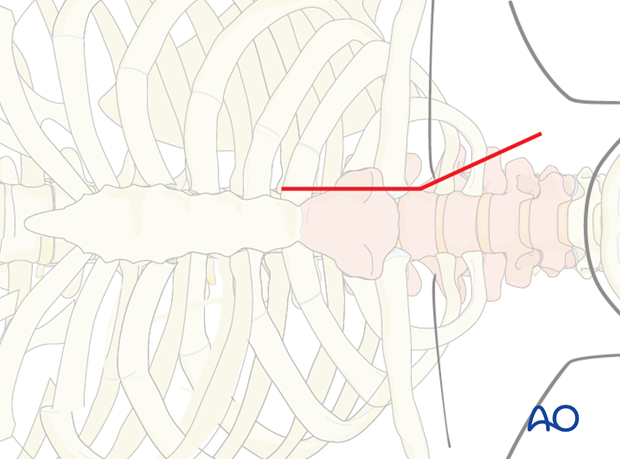 anterior approach to the cervico thoracic junction