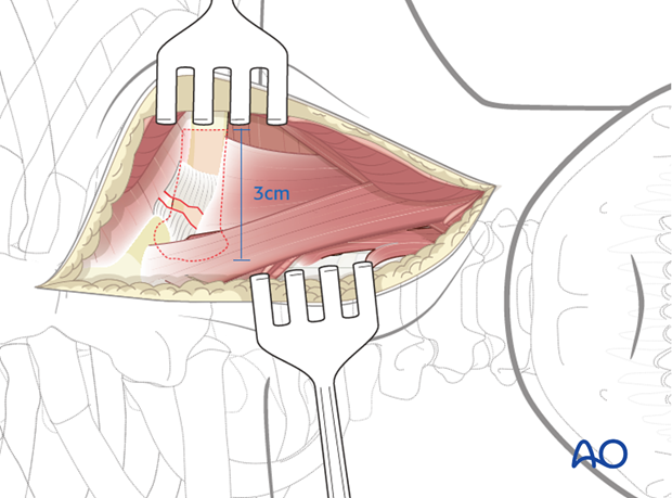 anterior approach to the cervico thoracic junction