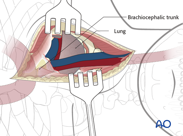 anterior approach to the cervico thoracic junction