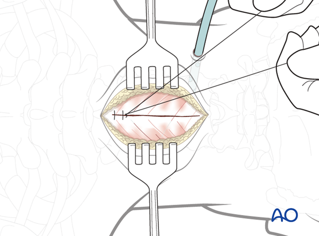 posterior approach to the cervical spine