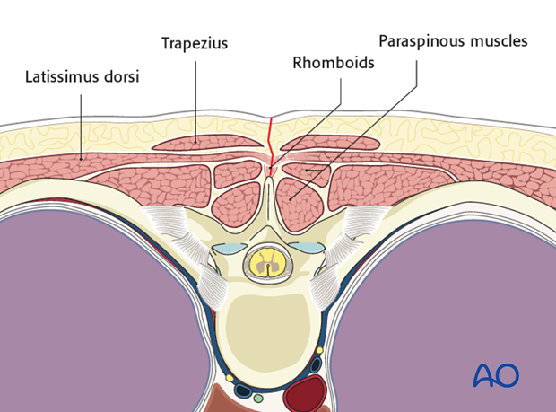 posterior access to the thoraco cervical junction