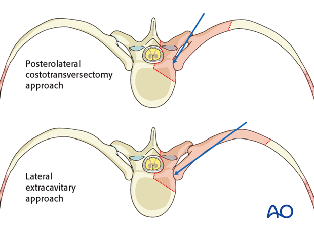 posterior access to the thoraco cervical junction