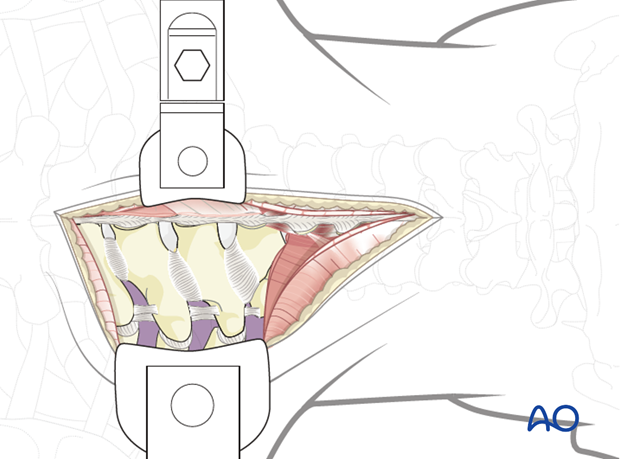 posterior access to the thoraco cervical junction