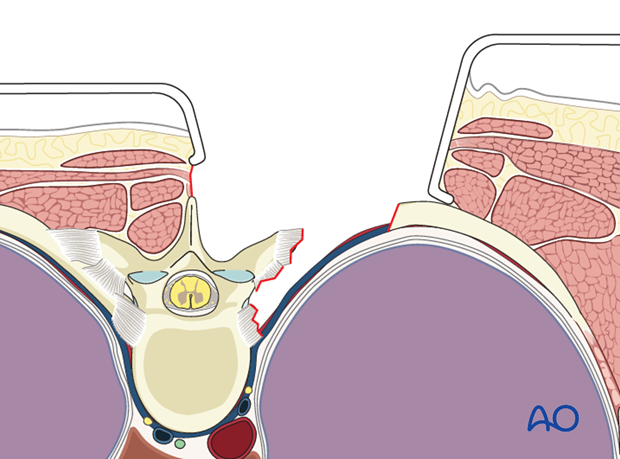 posterior access to the thoraco cervical junction