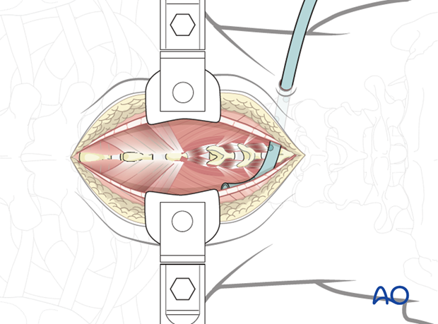 posterior access to the thoraco cervical junction