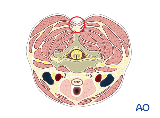 posterior approach to the cervical spine