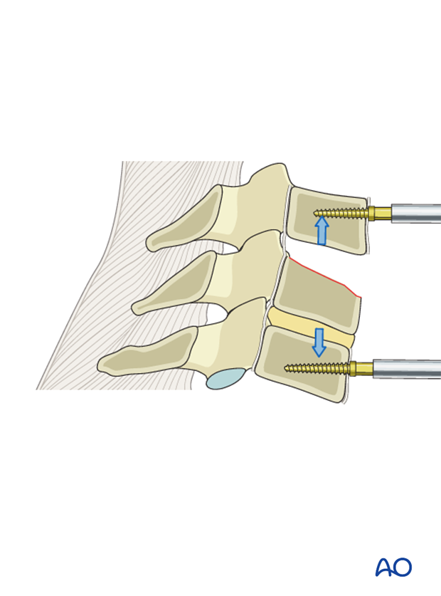 anterior plating