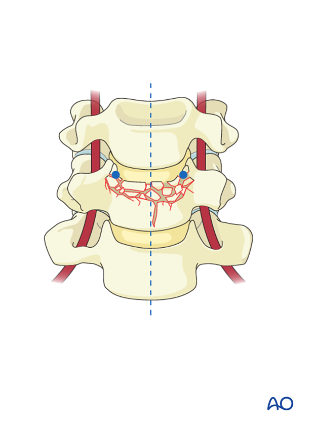 anterior plating