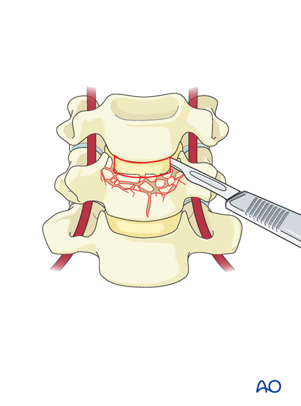 anterior plating