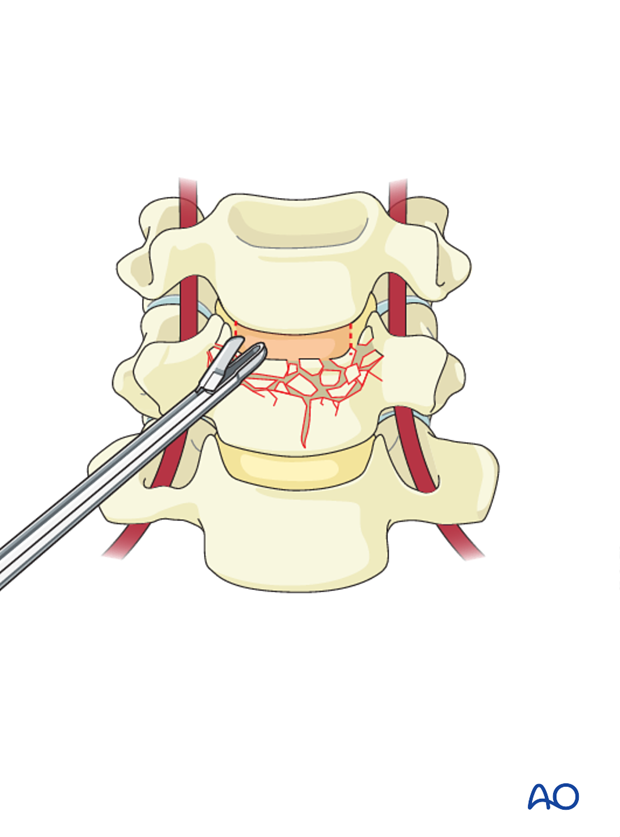 anterior plating