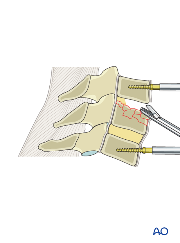 anterior plating