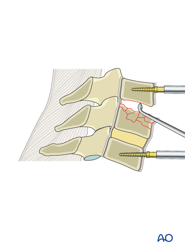 anterior plating