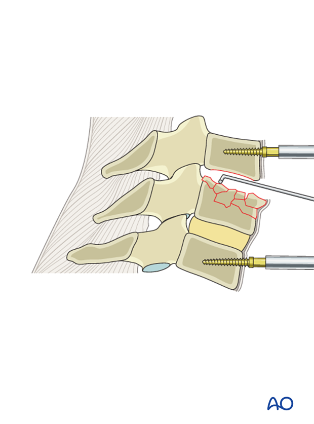 anterior plating