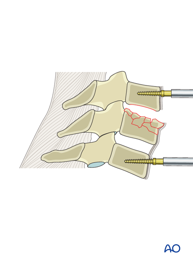 anterior plating