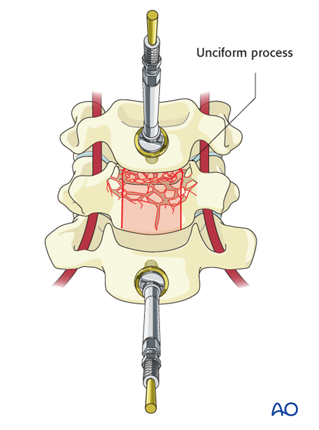 anterior plating