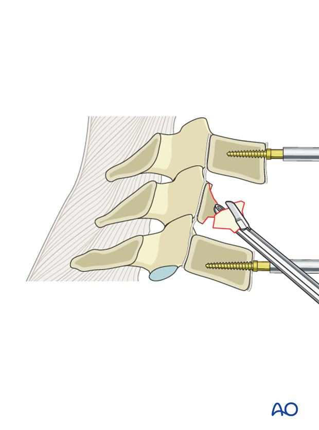 anterior plating