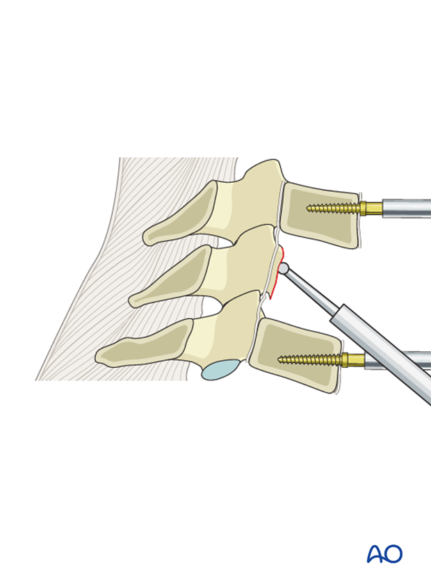 anterior plating