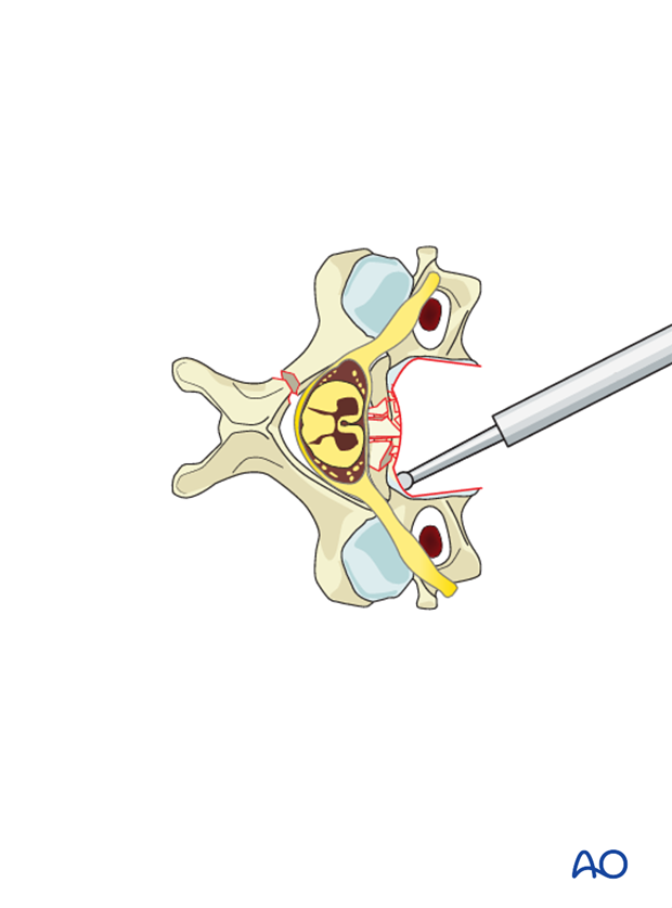 anterior plating