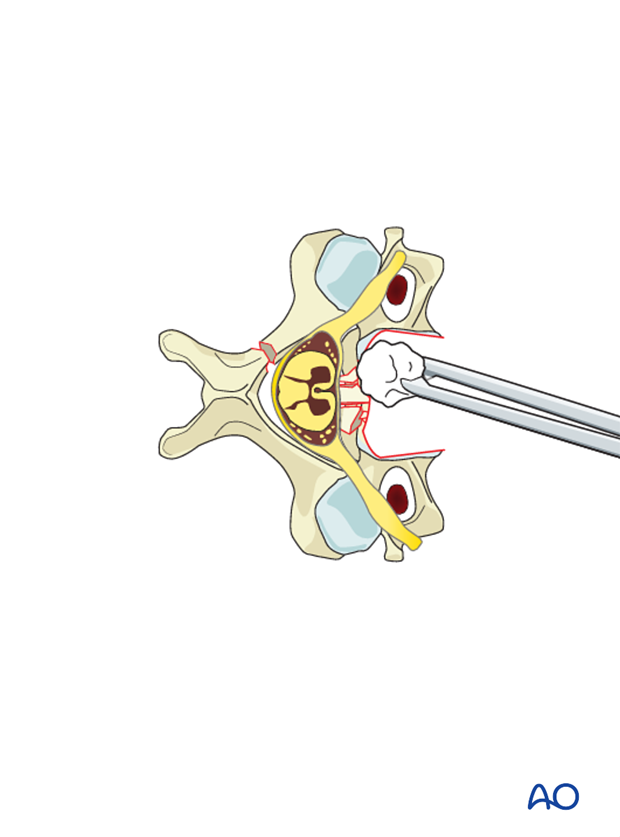 anterior plating