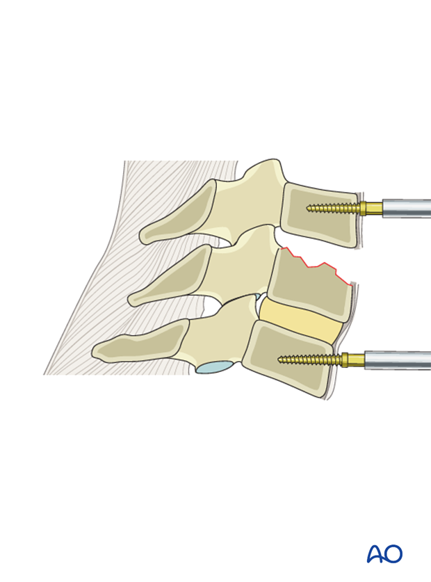 anterior plating