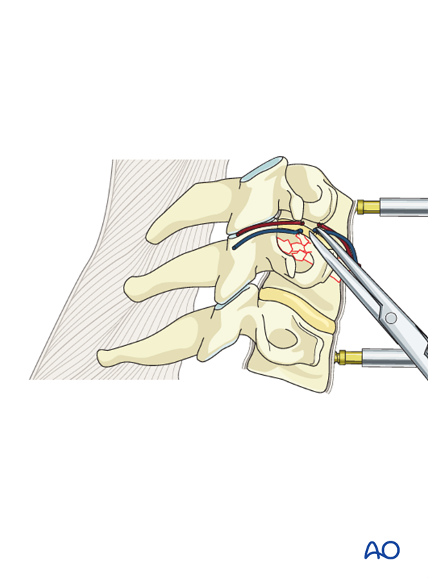 anterior plating