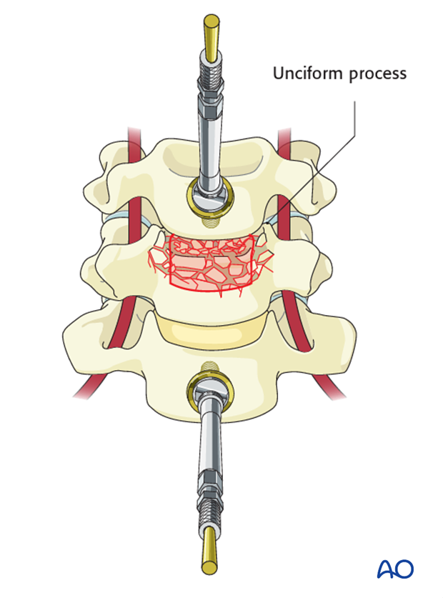 anterior plating