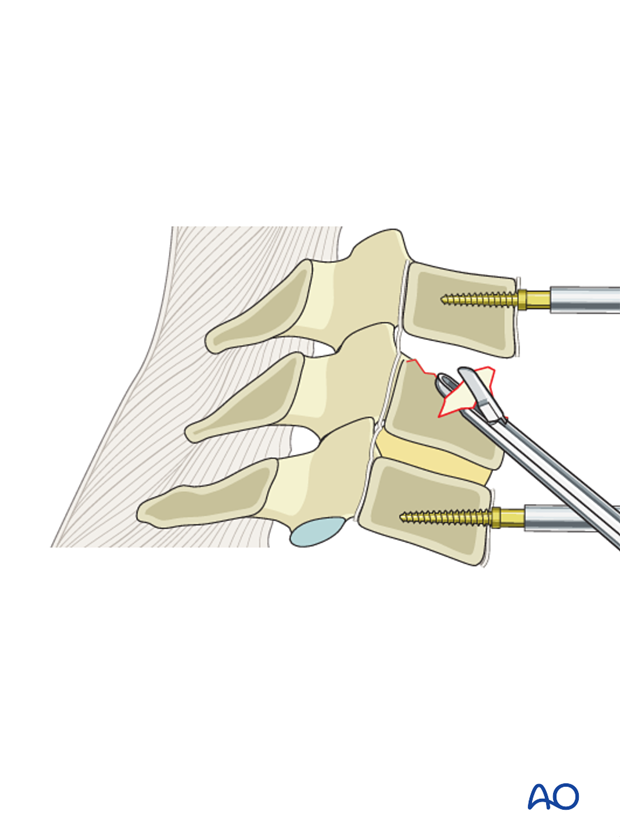 anterior plating