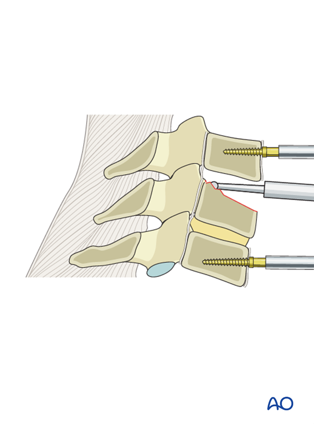 anterior plating