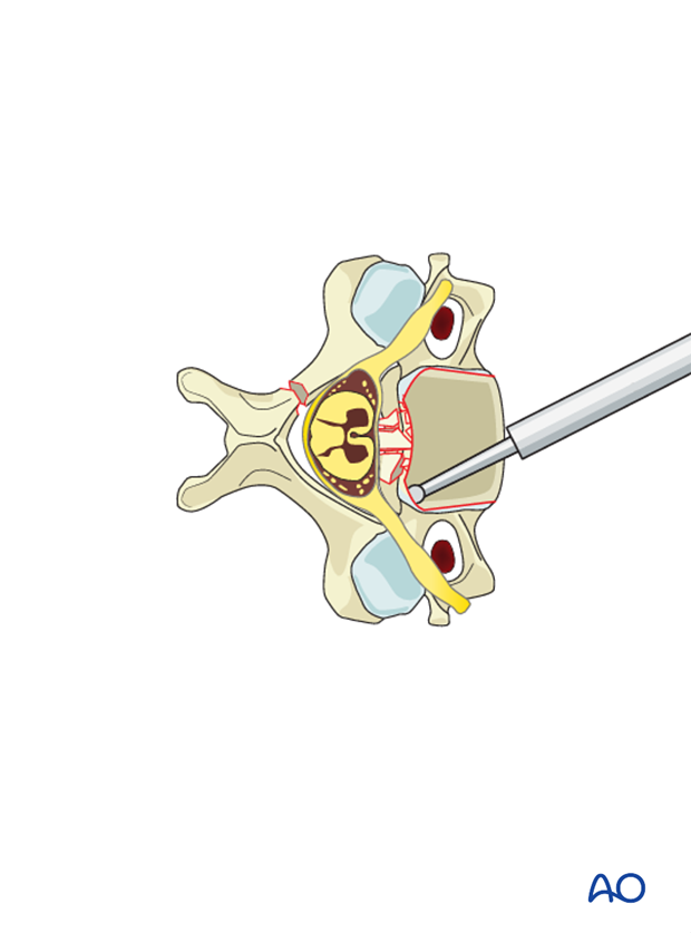 anterior plating