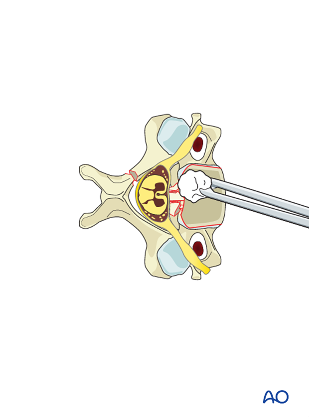 anterior plating