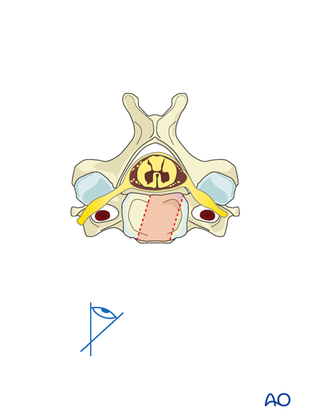 anterior plating