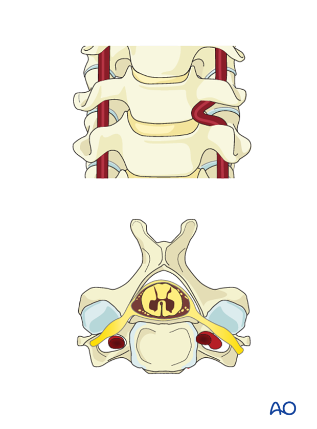 anterior plating