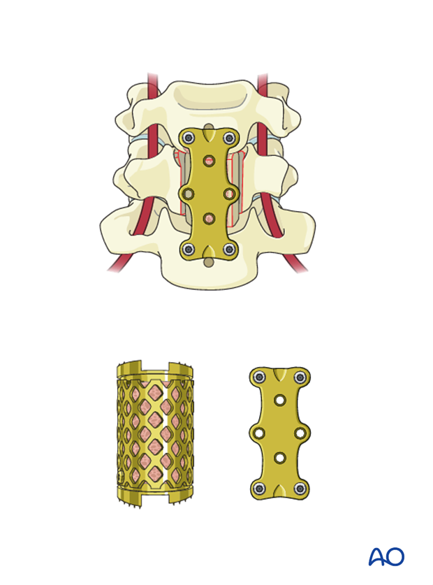 anterior plating