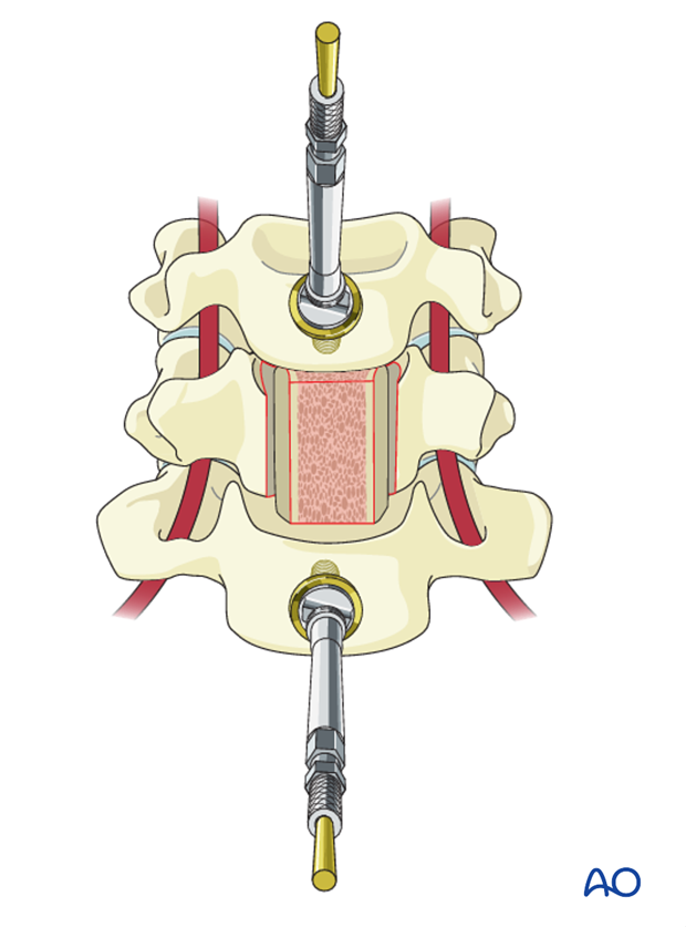 anterior plating