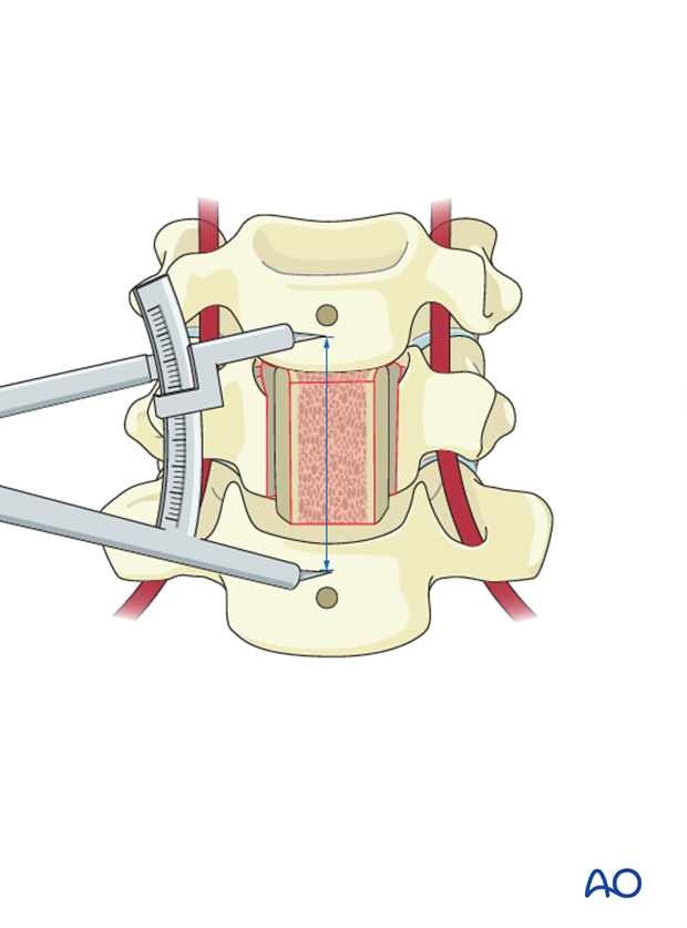 anterior plating