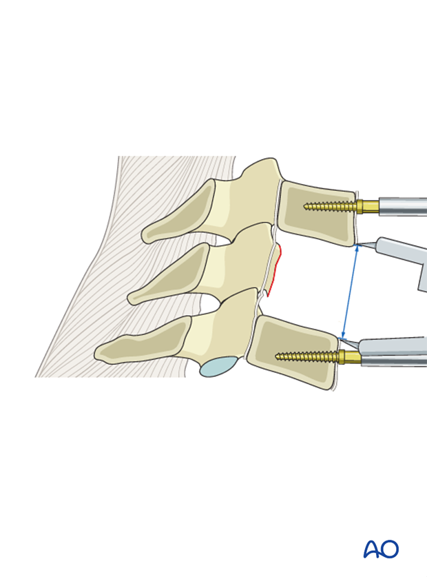 anterior plating