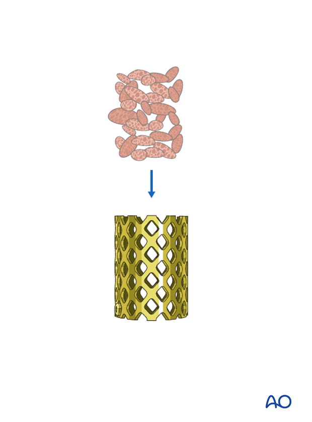 anterior plating