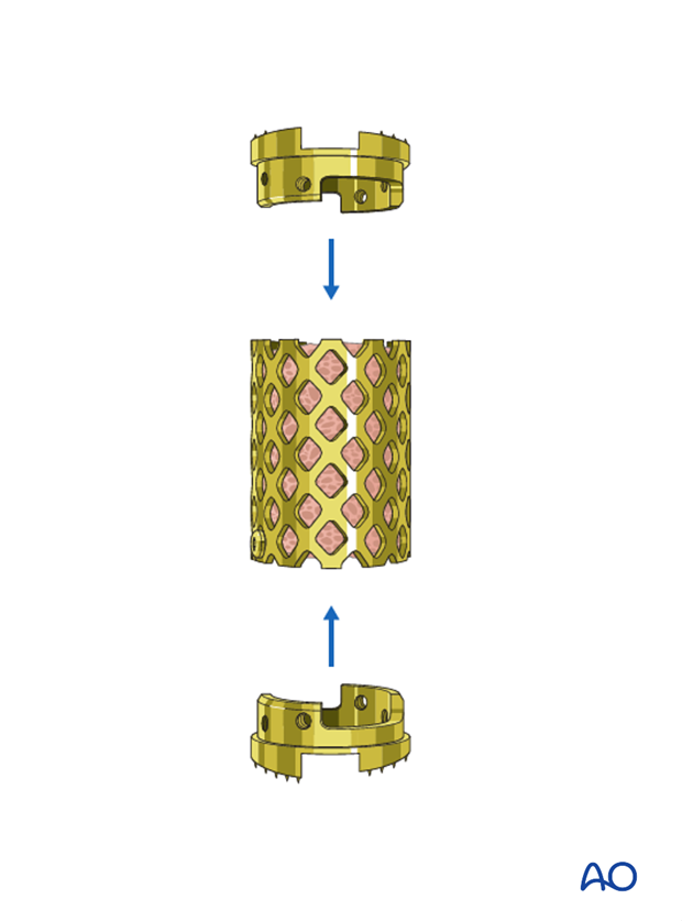 anterior plating