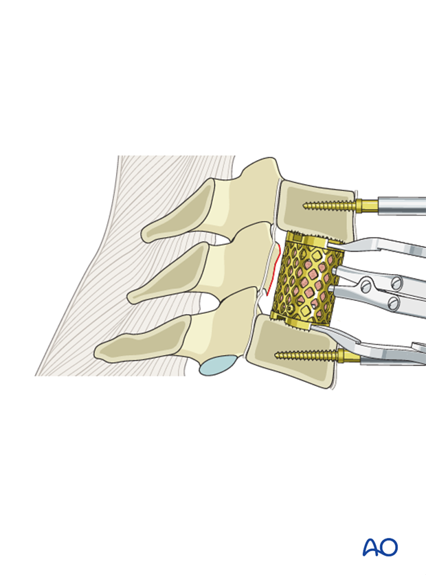 anterior plating