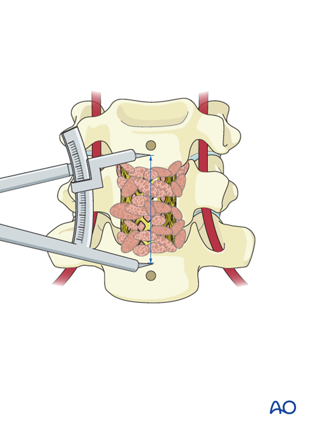 anterior plating