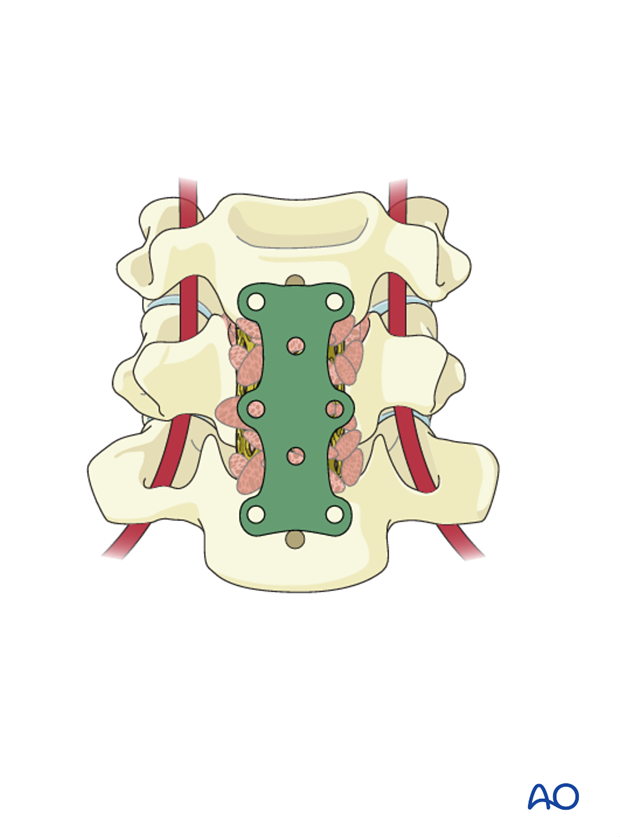 anterior plating