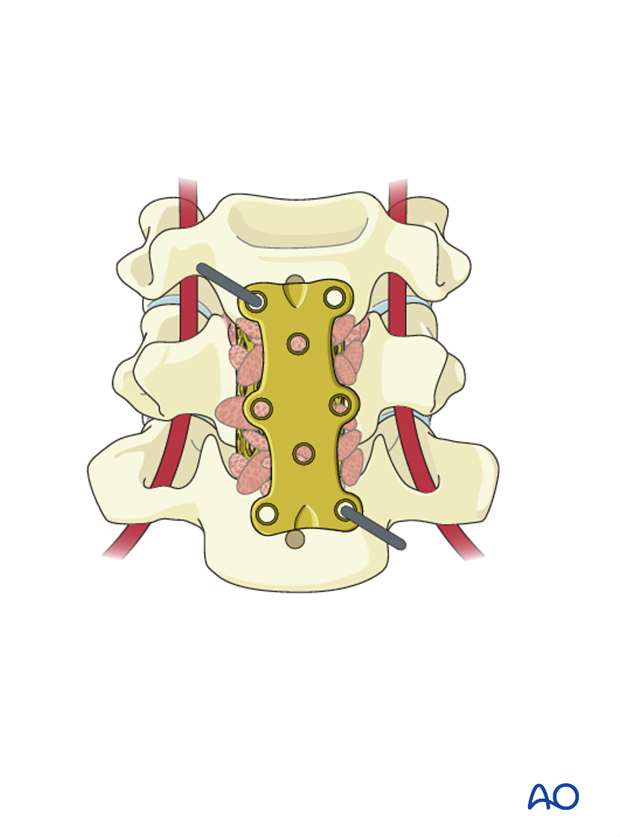 anterior plating