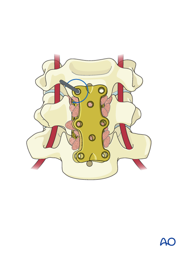 anterior plating