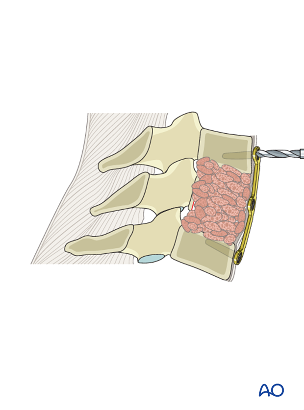 anterior plating